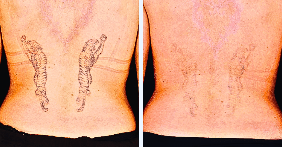 Tattoo removal from body before and after